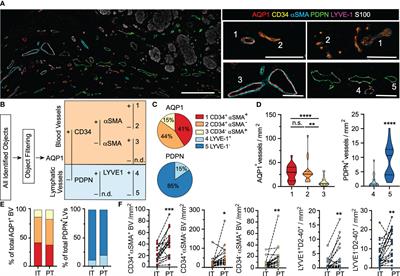 Quantitative multiplex immunohistochemistry reveals inter-patient lymphovascular and immune heterogeneity in primary cutaneous melanoma